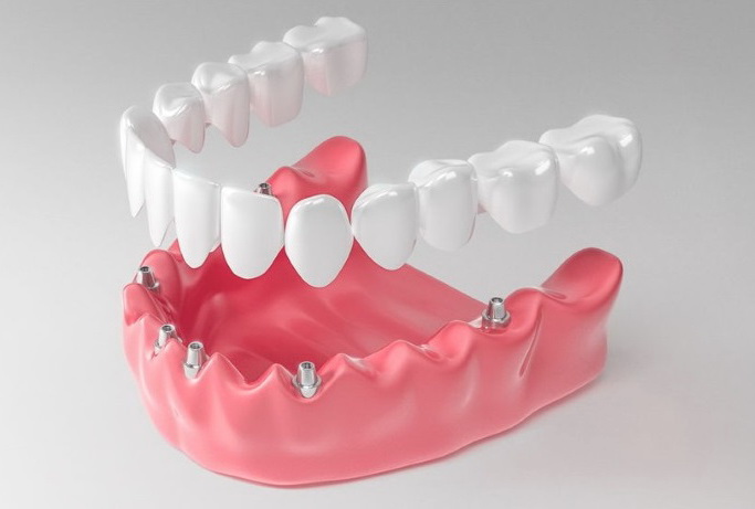 Имплантация зубов «Все на 6»