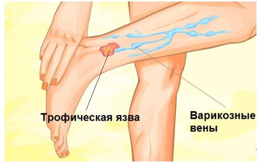 Флеболог это медицинский специалист по заболеваниям венозного происхождения