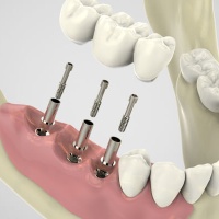 All on 6 имплантация и протезирование зубов